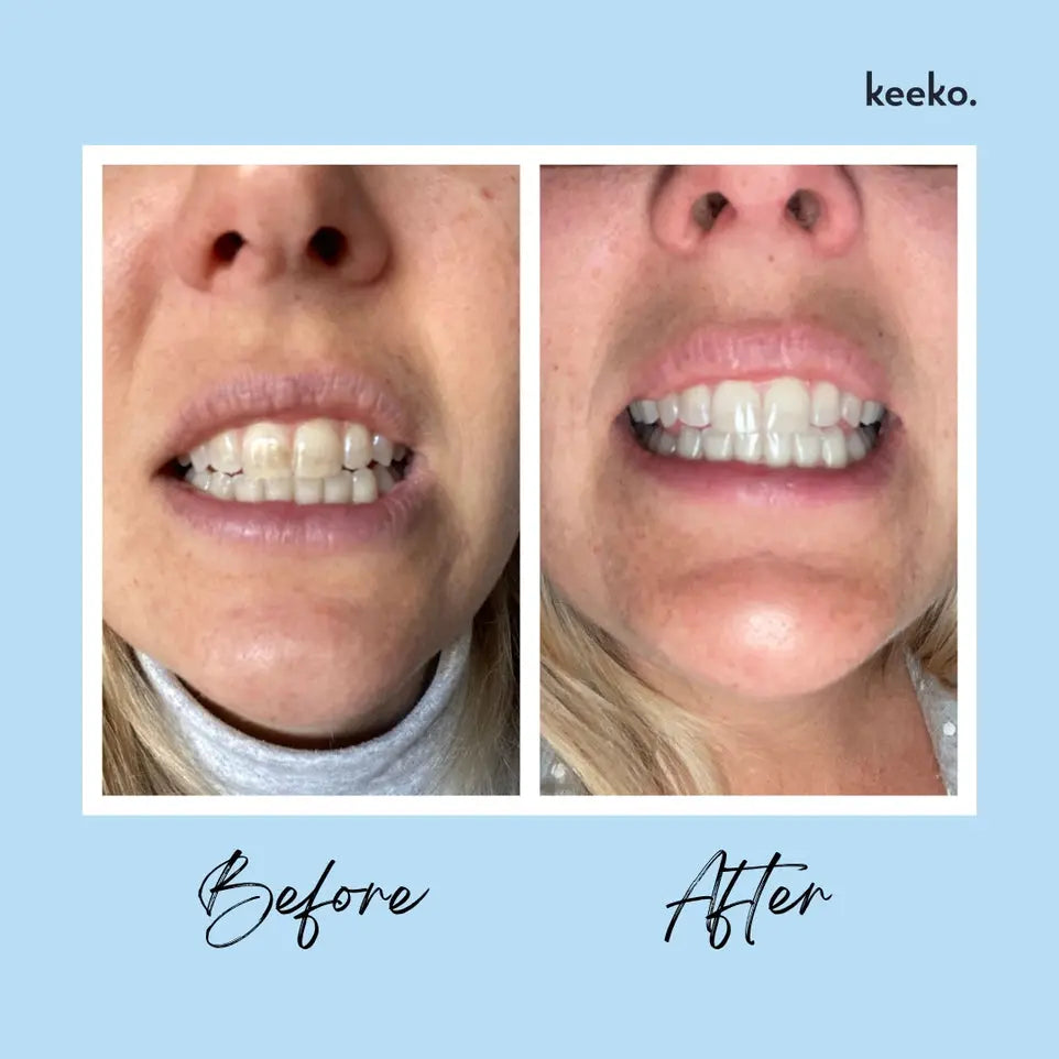 Keeko Botanical Whitening Pen before and after photo